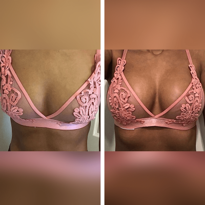 Boob Job Guide: Everything You Need to Know About Double Bra